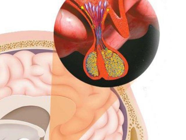 [건강한 가족] 호르몬 분비 조절하는 콩알만 한 뇌하수체 혹 생기면 건강 위협
