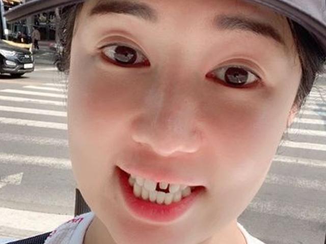 앞니 <strong>라미네이트</strong> 떨어진 사유리…"바람 잘 통해"