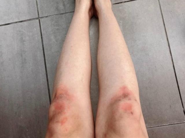 '컴백 예고' 선미, 멍투성이 된 다리 눈길…연습의 흔적