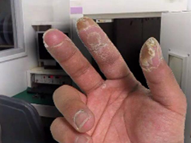 피폭으로 손가락 색 변했는데…서울반도체 "정상" 발표