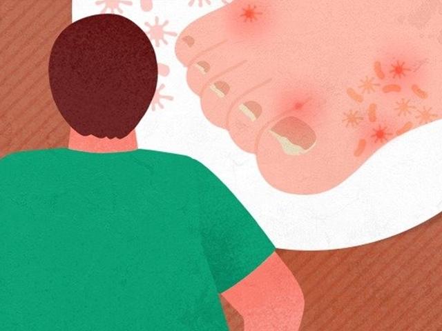 이젠 '뽀송뽀송' 김 대리는 어떻게 <strong>무좀</strong>을 잡았나