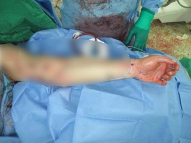 "軍병원으로 옮긴 이국종 제자…절단 위기 장병 팔 살렸다"