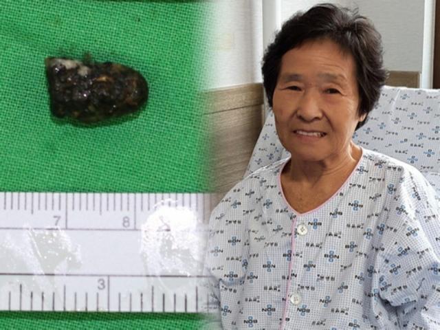 분단의 비극 담은 총알 70년 만에 무릎에서 꺼낸 81세 할머니