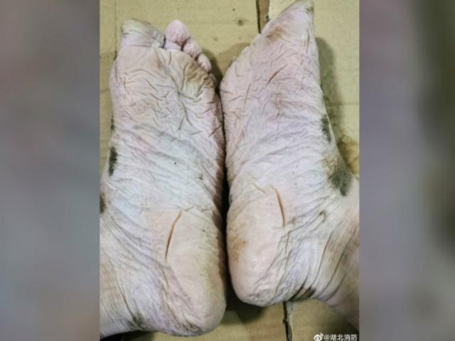 징그럽다고요? 30시간 동안 실종자 수색한 소방관의 발입니다