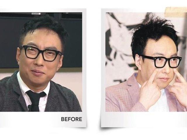 박명수도 했다는 눈밑 <strong>지방</strong> 재배치 수술, 실제로 해봤더니