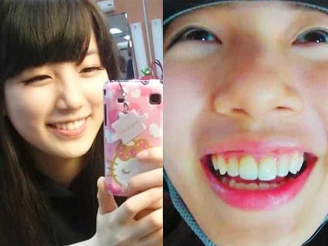 “수지도 했다” 안 한 연예인 없지만 다들 뜯어말린다는 수술