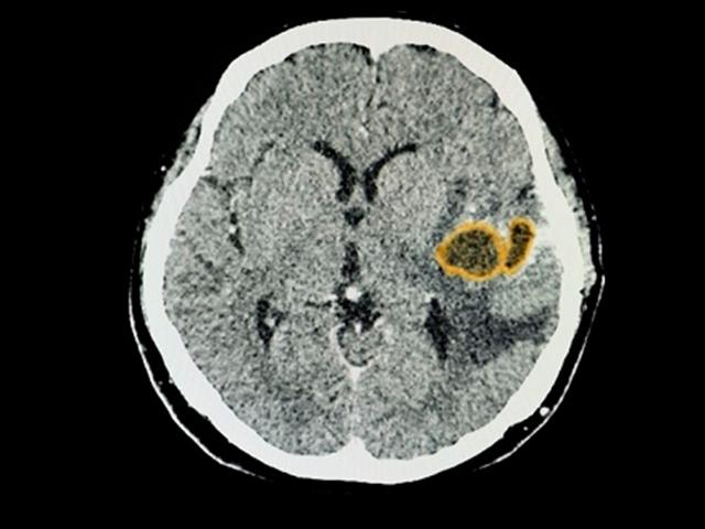 뇌 질환 의심될 땐?...저렴한 CT vs 비싼 MRI