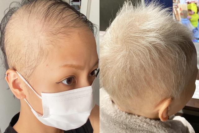 ‘흰머리까지..’ <strong>코로나</strong> <strong>백신</strong> 맞은 여성이 공개한 심각한 부작용 수준