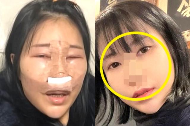 부기+테이핑 충격 비주얼…<strong>성형수술</strong> 후기 공개한 개그우먼