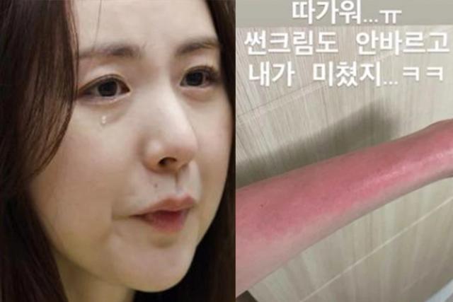 “내가 미쳤지” … 빨갛게 다 타버린 팔 인증한 여가수, 도대체 무슨 일?