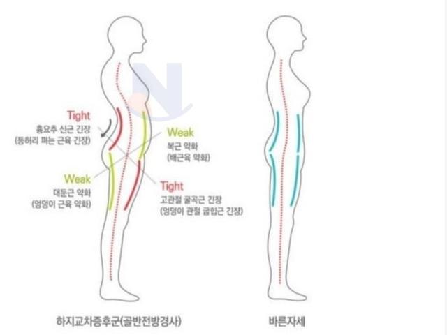 코어<strong>근육</strong>이 완전히 무너진 사람들 특징