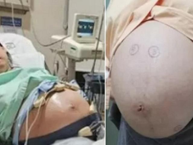 6,500만 분의 1 확률로 ‘오둥이 자연<strong>임신</strong>’ 한 여성 “선택적 유산 권유받기도”