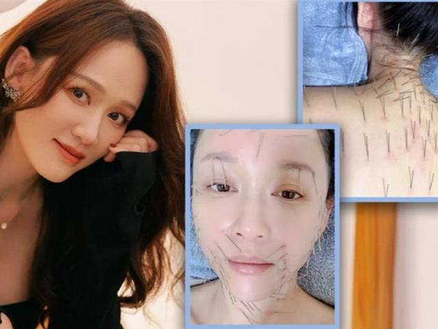 온 몸에 100개 넘는 침을?…실침 시술 받는 대만 女배우 화제