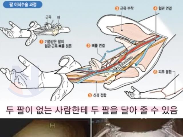 머리 전체를 이식하는 수술까지도 <strong>성공</strong>한.. '현대 의학이 손도 못대고 있는 영역'