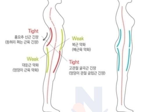 코어 근육이 무너진 <strong>사람</strong>들 특..