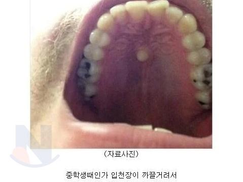 입천장에 난 치아 <strong>레전드</strong>... ㄷㄷㄷ
