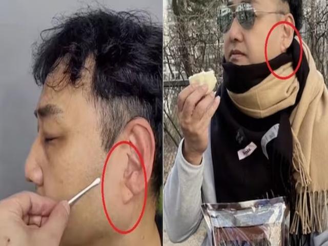 귓불 사선 주름, 정수리 탈모... 우리 몸이 보내는 경고를 무시말라