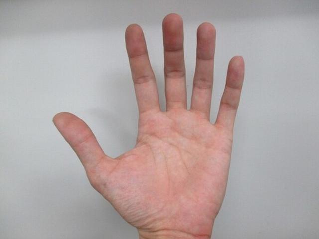 만약 손가락에 "이런 증상" 느껴진다면 바로 병원부터 가야합니다.