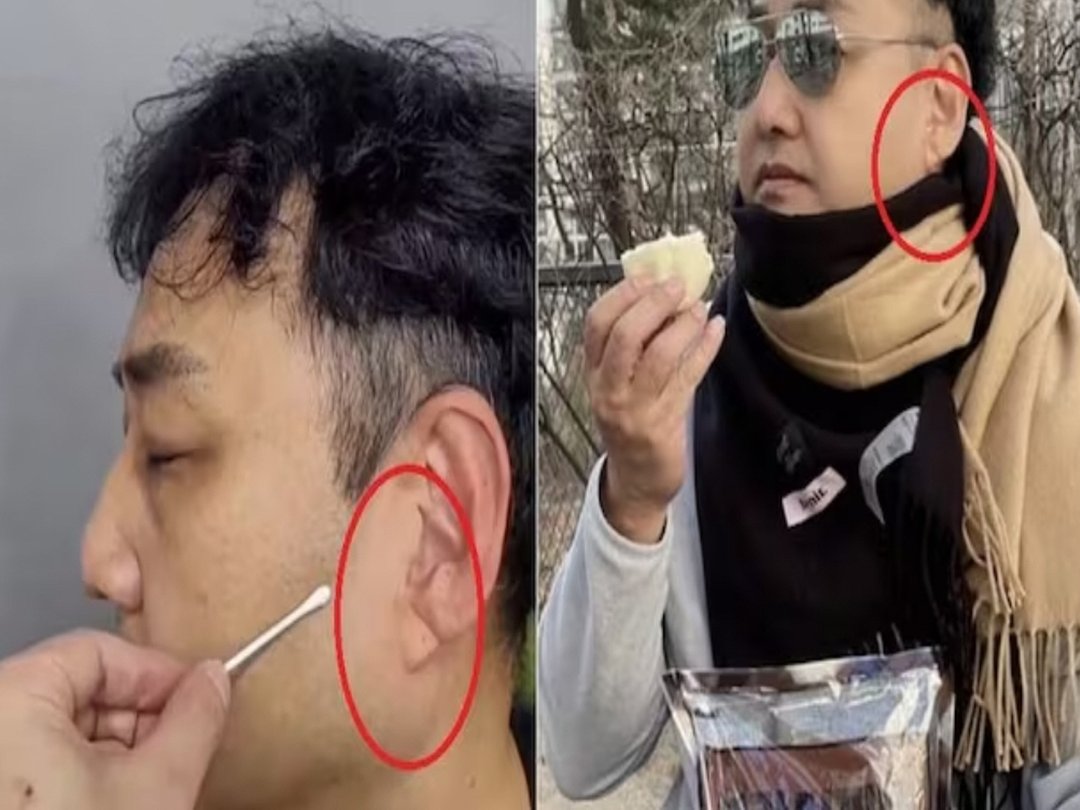 귓불 사선 주름, 정수리 탈모... 우리 몸이 보내는 경고를 무시말라