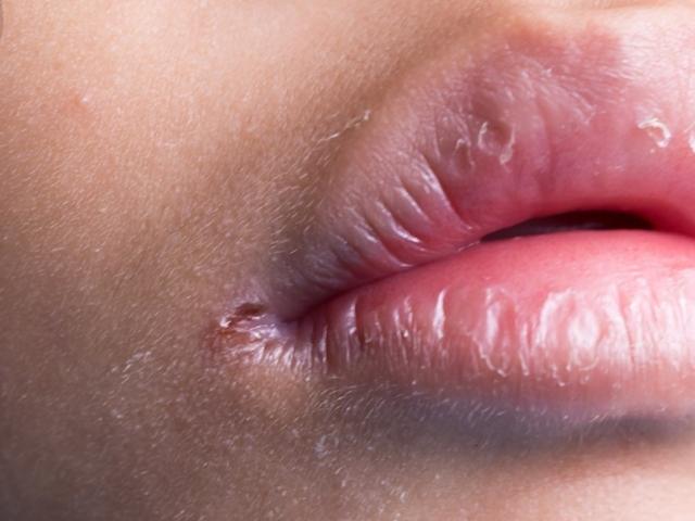 알고 보니 헤르페스 감염? 입술 뾰루지별 원인과 치료법