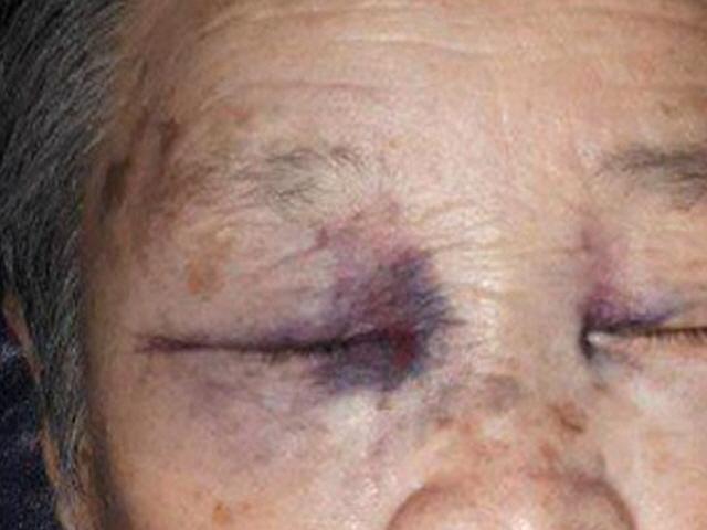 요양원 모신 88살 노모 입소 하루 만에 피멍…CCTV는 가짜