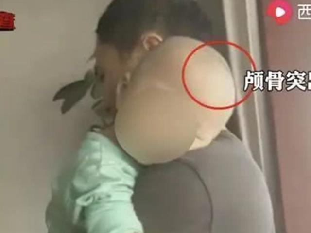 중국 또 가짜분유 부작용 논란... 두개골 커지는 '구루병' 유발